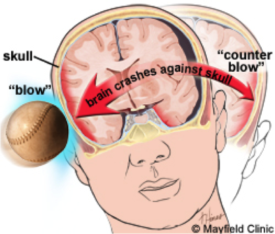 Concussion Impact On Concussions