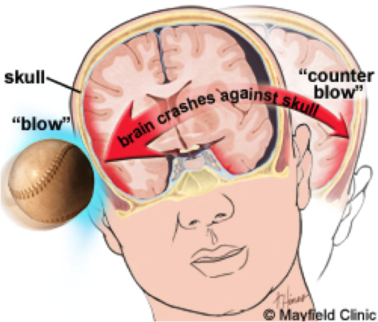 led-head-harness-provides-breakthrough-for-concussions-bowen