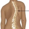 scoliosis