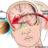 LED “Head Harness” Provides Breakthrough for Concussions! Concussion